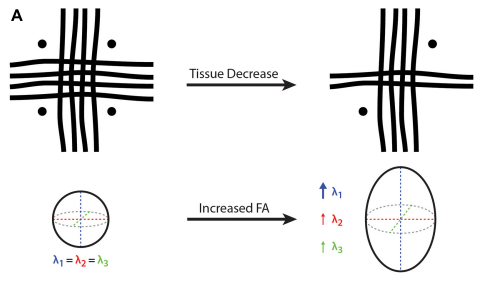 DTI limitations in crossing fibres — case A
