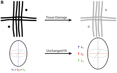 DTI limitations in crossing fibres — case B